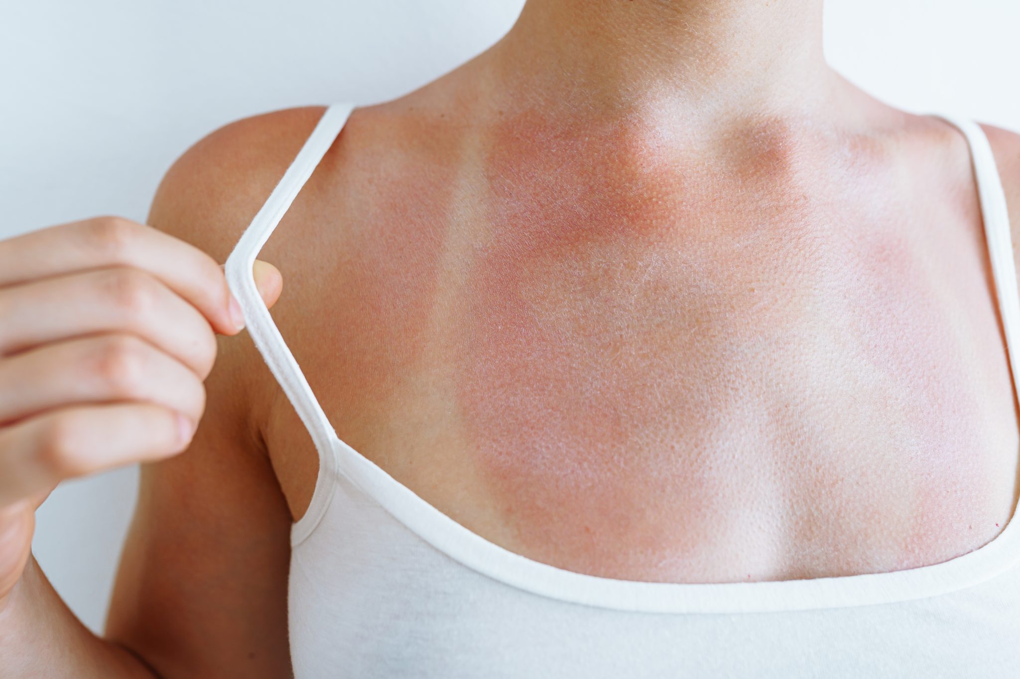Une personne expose sa poitrine brûlée par le soleil, révélant des lignes de bronzage nettes dues à un débardeur. Les zones rouges et irritées soulignent l'étendue des dommages causés par le soleil, contrastant fortement avec les zones de peau d'origine. Consciente de l'inconfort, elle ajuste la bretelle de son débardeur blanc.