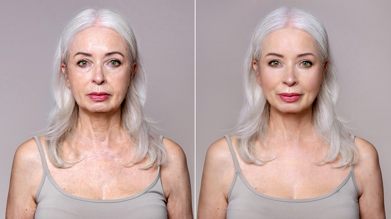Avant et après côte à côte d'une femme mature montrant une amélioration subtile des joues et de la mâchoire après une procédure de lifting par fils.